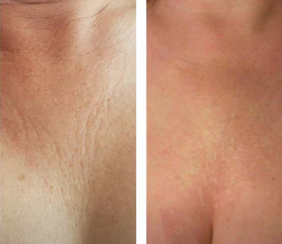 Skin Tightening