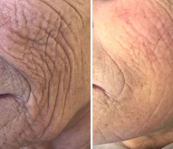 Skin Tightening