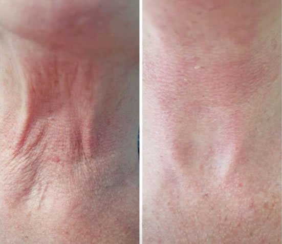 Skin Tightening