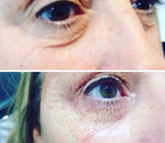 Non Surgical Facelift